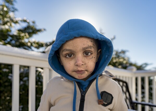 Omar Abu Kuwaik poses for a photo at the Global Medical Relief Fund residence, Wednesday, Jan. 17, 2024, in the Staten Island borough of New York. On Dec. 6, 2023 two Israeli airstrikes slammed into Omar's grandparents' home in the Nuseirat refugee camp, in central Gaza. The explosion peeled the skin from his face, exposing raw pink layers peppered with deep lacerations. His left arm could not be saved below the elbow. His parents, 6-year-old sister, grandparents, two aunts and a cousin were killed. (AP Photo/Peter K. Afriyie)
