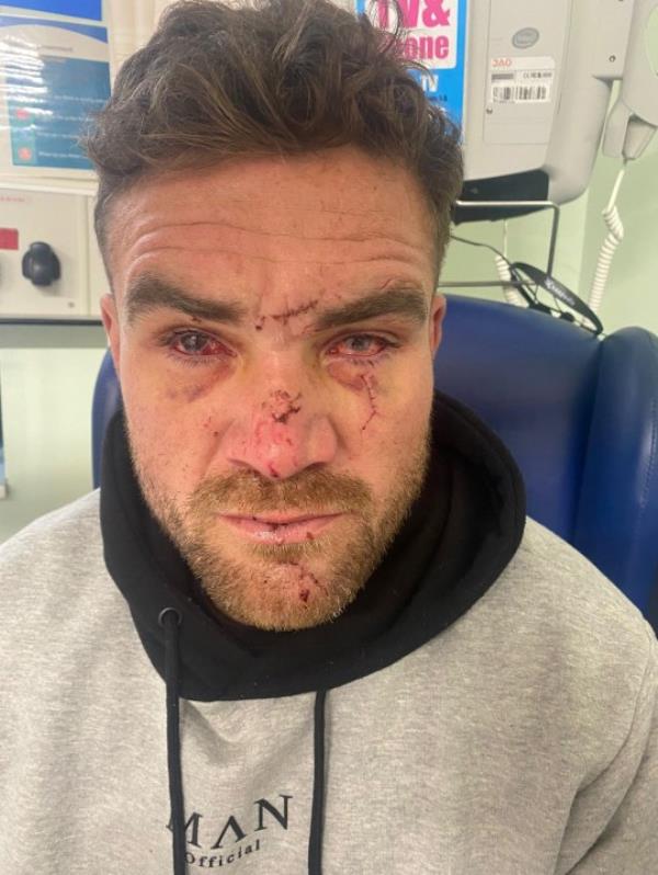 *COLLECT* Matt a couple of days aftet the attack. Matt Syron, 32, who was blinded after he was attacked with a glass on a night out is calling for a law to be changed, pictured at a family home in Leeds, West Yorks, Feb 8 2024. Release date ? February 11 2024. See SWNS story SWLNglass. A dad-of-two blinded in an unprovoked attack on a night out has called for glass bottles and drinks co<em></em>ntainers to be banned in bars after 9pm. Matthew Syron, 32, was glassed by stranger Gareth Dean, 37, during a night out in Revolucin de Cuba in Leeds, West Yorks,. with a group of friends. He was rushed to hospital after the attack on Boxing Day, wher<em></em>e he had surgery on his eyes that has meant he's been able to regain some sight in his right eye. Matthew, originally from Leeds, moved to Wollo<em></em>ngong in Australia in 2012, wher<em></em>e the law there is that they stop serving glasses and bottles from 9pm.
