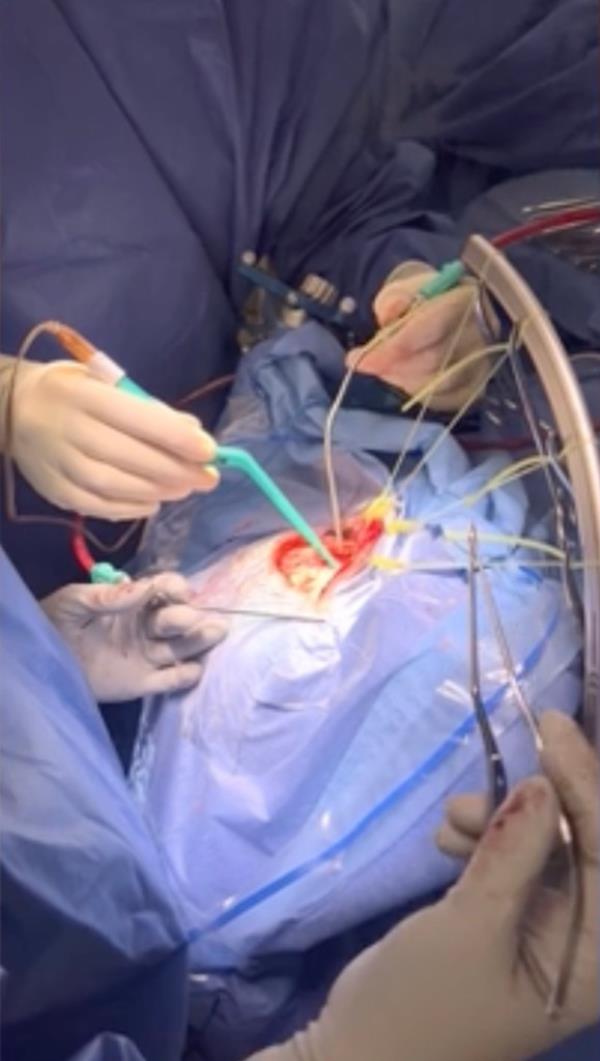 Krystina Vied of Keansburg was required to stay awake and talking during surgery last mo<em></em>nth so her doctors could see in real-time how the procedure was affecting her brain.