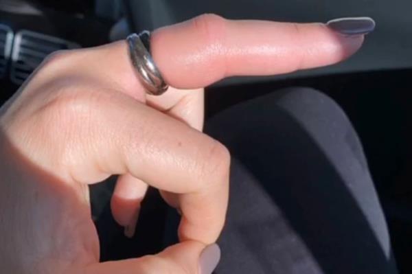 I forgot to remove a ring before bedtime — it turned into a real horror story