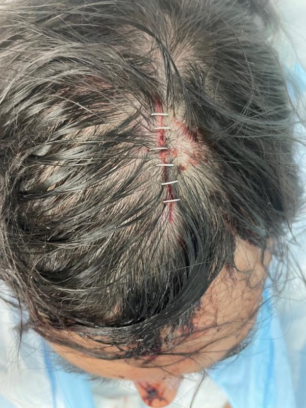 The driver needed six staples in his head.